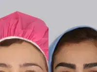 کاشت ابرو با جراحی بهتر است با بدون جراحی؛ کدام روش برای شما مناسب‌تر است؟