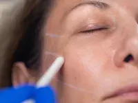 عوارض احتمالی جراحی لیفت صورت که باید بدانید