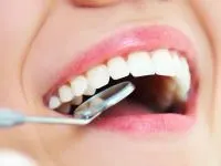 تفاوت کامپوزیت با لمینت دندان و مزایا و معایب هر کدام